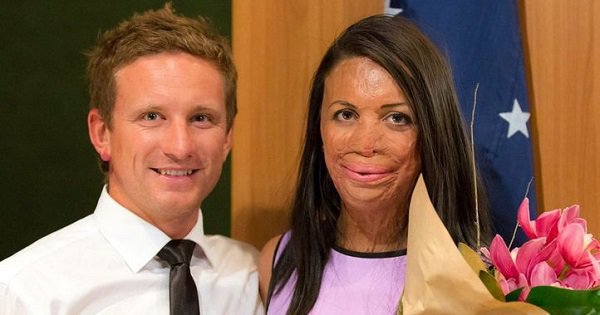 This incredible photo story of a burn victim proves that true love still exists - scoopwhoop