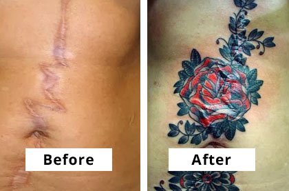 Can You Tattoo Over Scars  TattooProfy