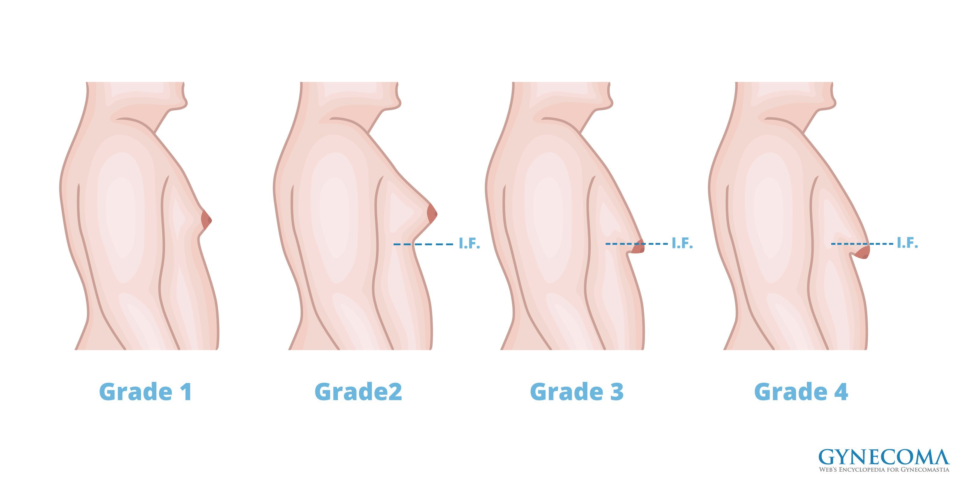 This Guy Developed Breasts Apparently It s Because He Drank Soy