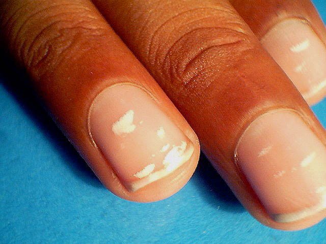 Those White Marks On Your Nails Don't Appear Because Of Calcium Deficiency.  Here's The Actual Reason