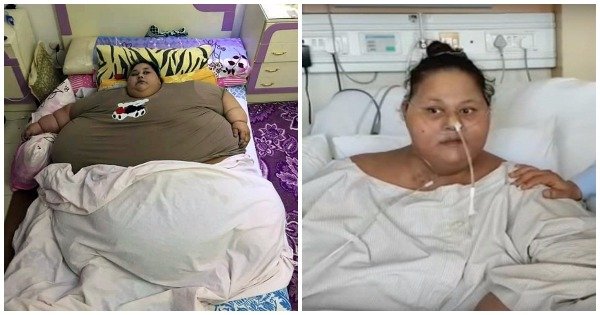 Worlds Heaviest Woman Loses Half Her Weight In 2 Months After Coming To India For Treatment 3829