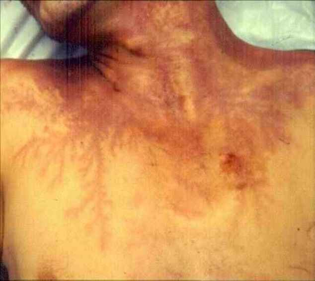 cool lightning scars