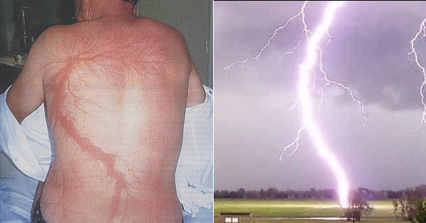 These 15 Pictures Of Lightning Strike Survivors Will Make You Realise 