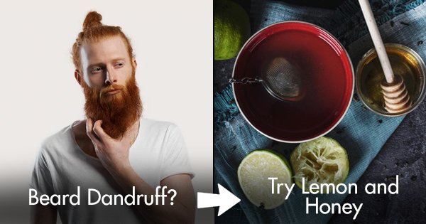 5 home remedies to try for a dandruff-free beard - scoopwhoop