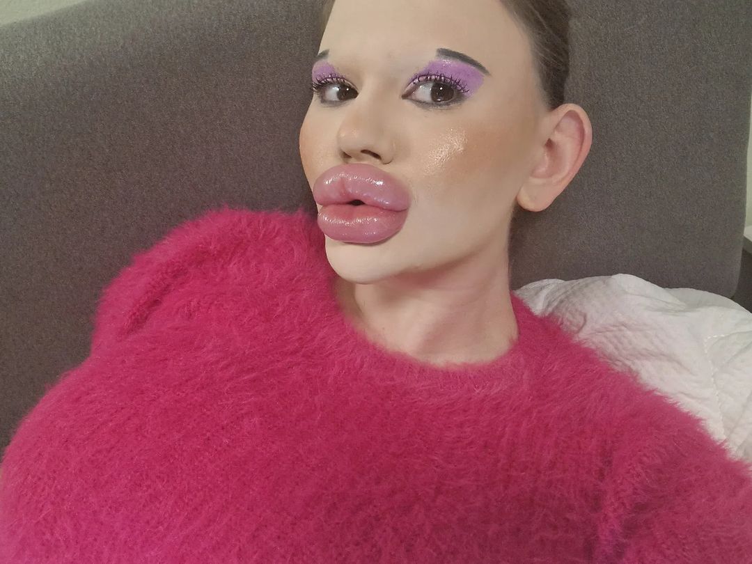 Meet Andrea Ivanova, The Woman Who Spent ₹7.5 Lakhs To Possess The World's  Biggest Lips - ScoopWhoop