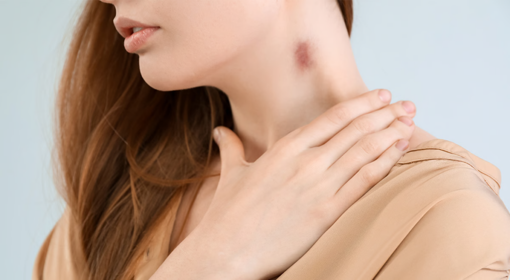 How to give a hickey