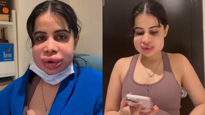 Uorfi Javed shows swollen face after lip filler removal, reveals if she can speak - India Today